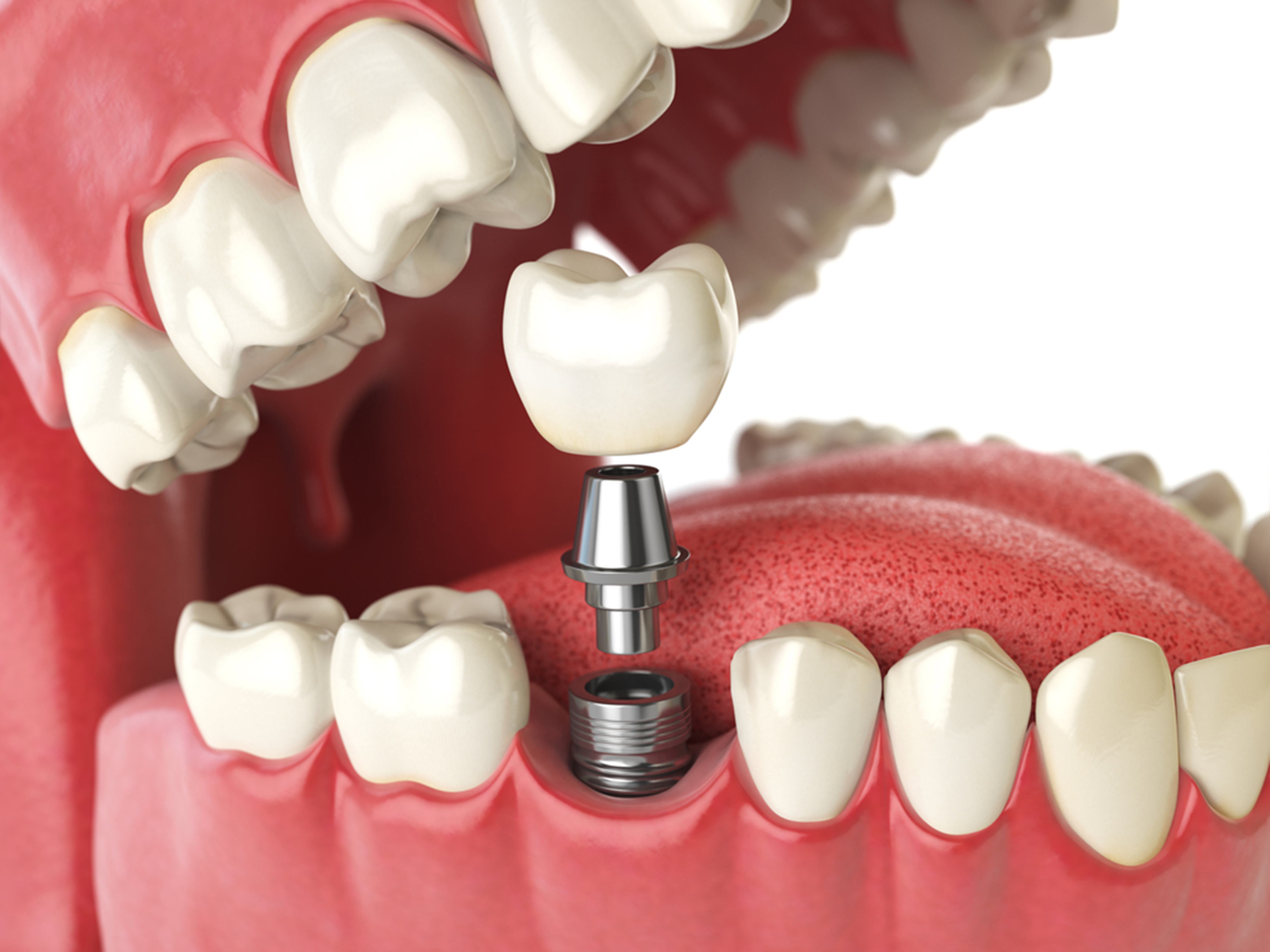 six words about dental implants&hellip; starting with lifespan
