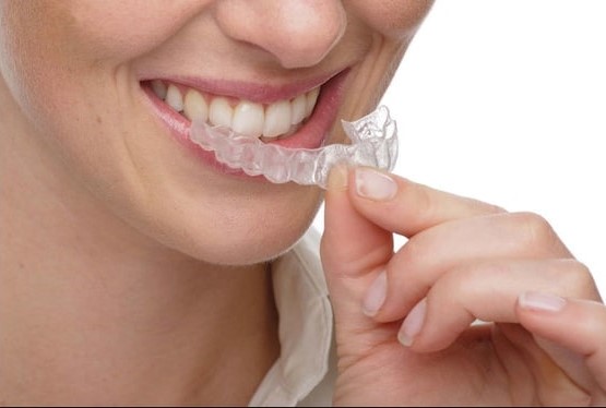 invisalign in varsity