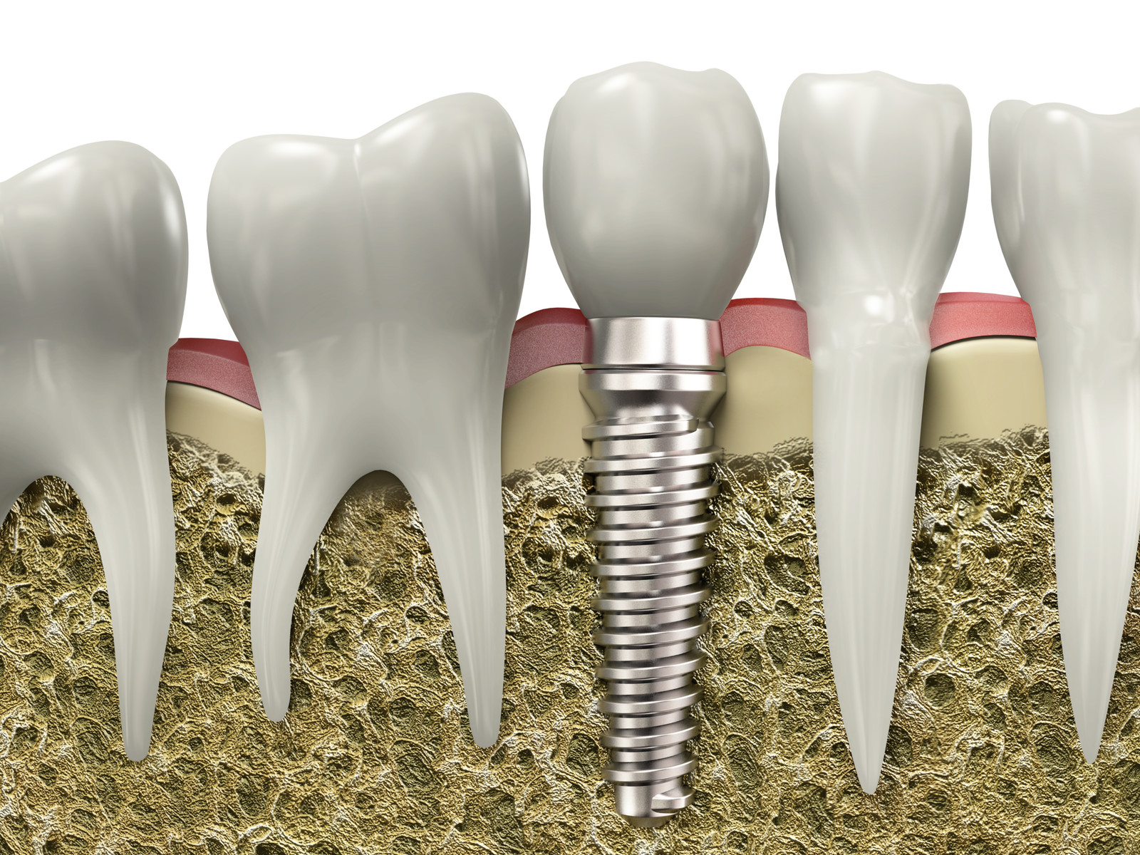 Dental Implants in Varsity